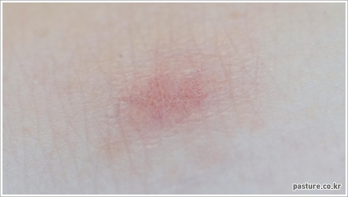 접촉성 피부염의 원인 증상 치료 완벽 가이드 접촉성 피부염의 원인 증상 치료 완벽 가이드